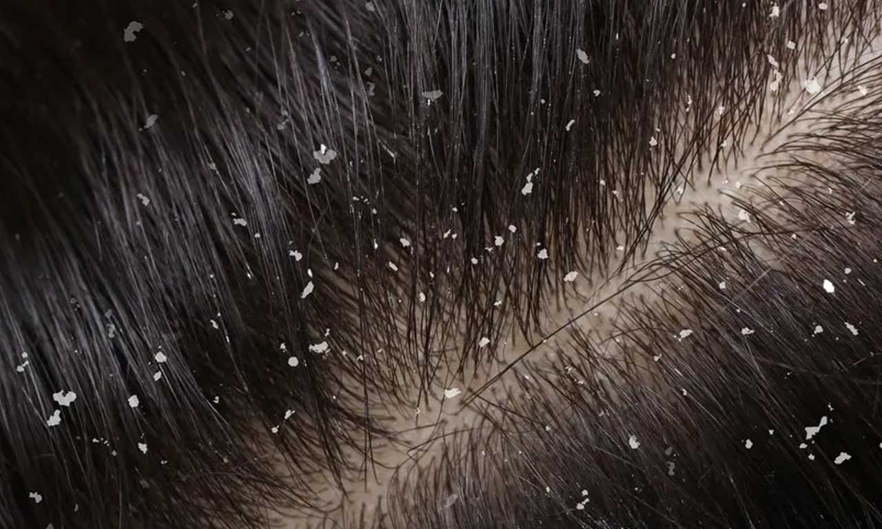 why dandruff keeps coming back