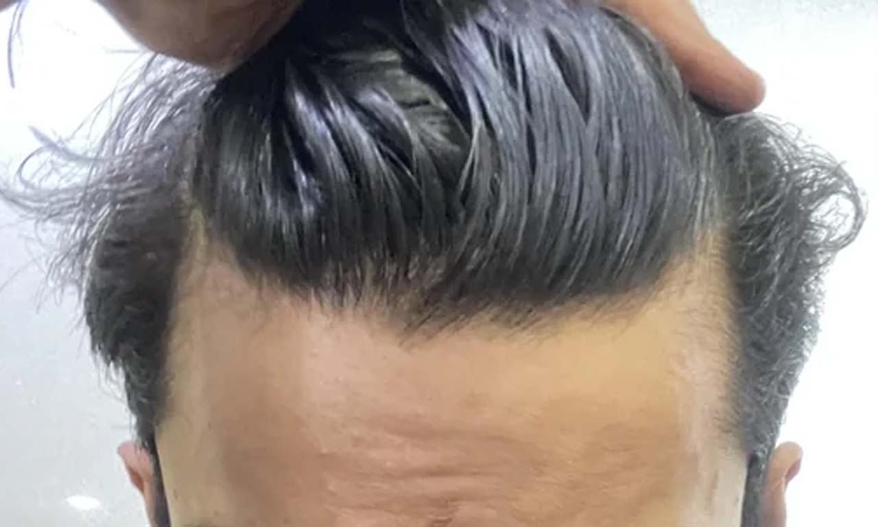 hair loss for men reason