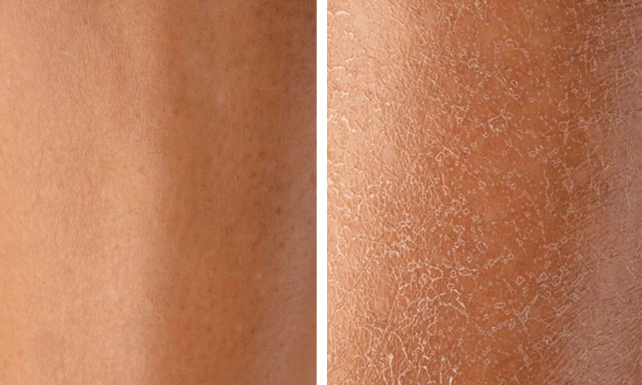 why is my skin dry after moisturizing