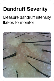 dandruff severity