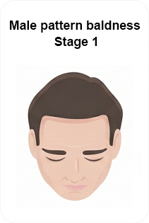 male pattern baldness stage 1
