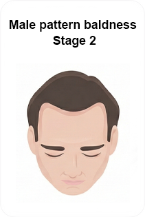 male pattern baldness stage 2