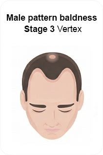 male pattern baldness stage 3 vertex