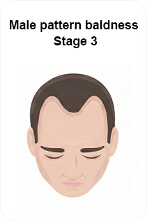 male pattern baldness stage 3