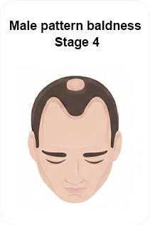 male pattern baldness stage 4