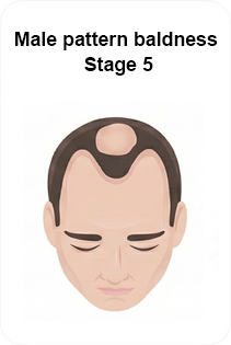 male pattern baldness stage 5