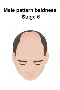 male pattern baldness stage 6