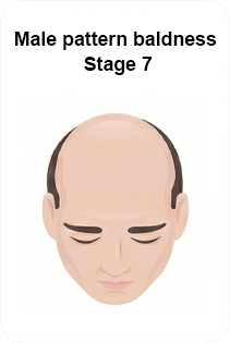 male pattern baldness stage 7