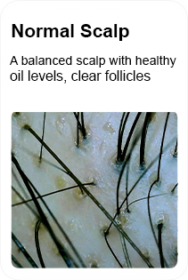 normal balanced scalp